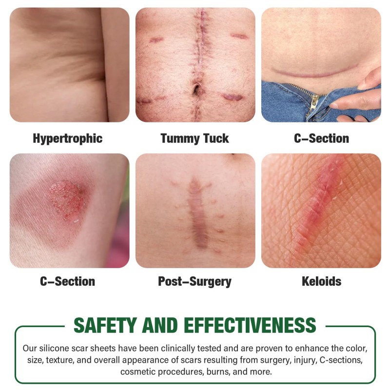 Silicone Scar Patch Factory - OEM ODM Lightening Self-Adhesive