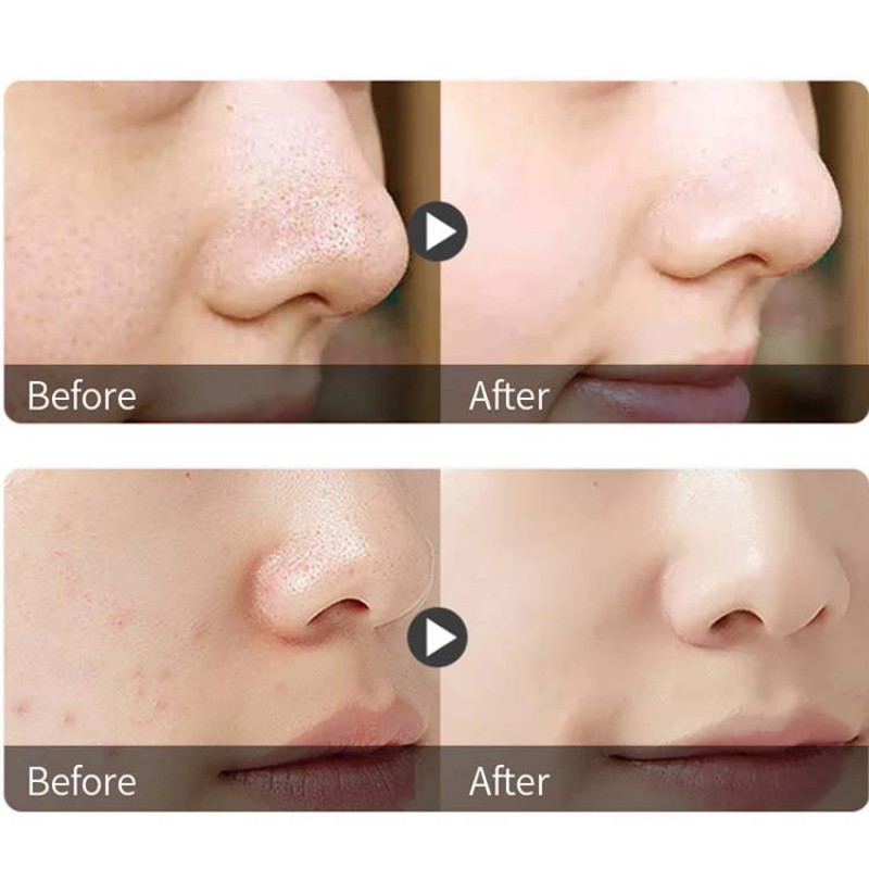 Blackhead Remover Supplier - OEM 3 Step Nose Acne Clean Beauty Kit