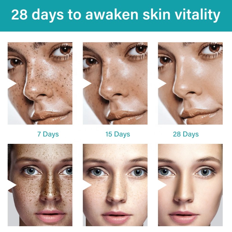 Whitening Cream Manufacturer - OEM Strong Freckle Melasma Melanin Remover