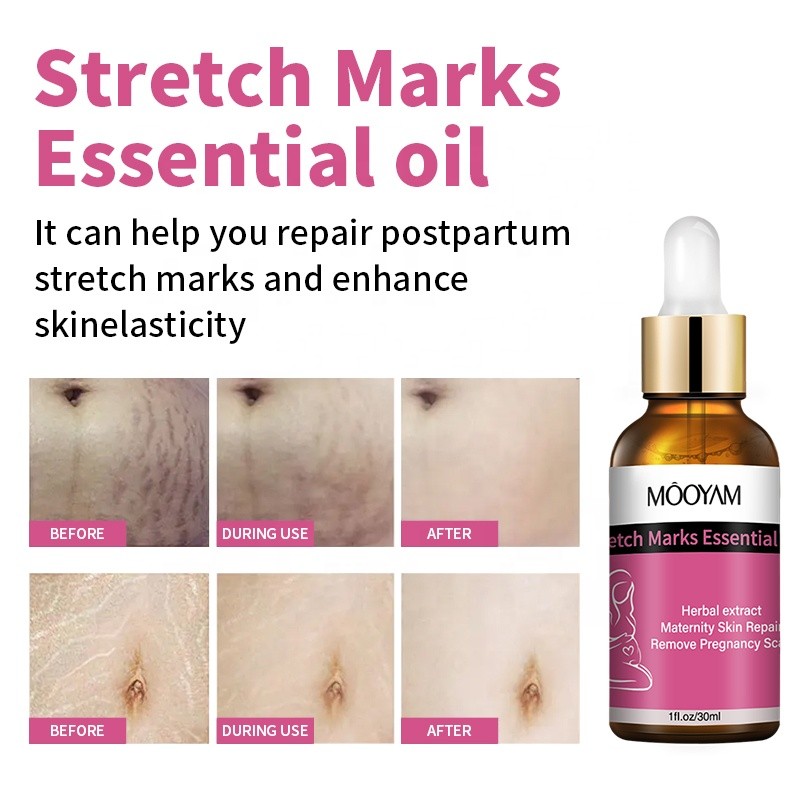 Stretch Mark Oil Factory - OEM Effective Repair Pregnancy Scar