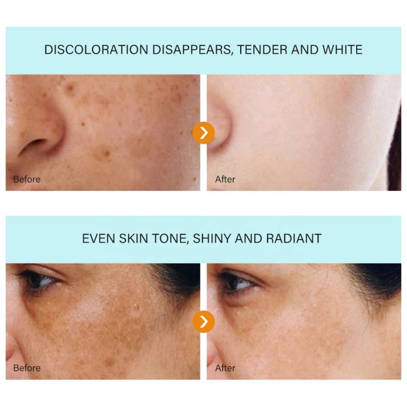 Whitening Cream Manufacturer - OEM Strong Freckle Melasma Melanin Remover
