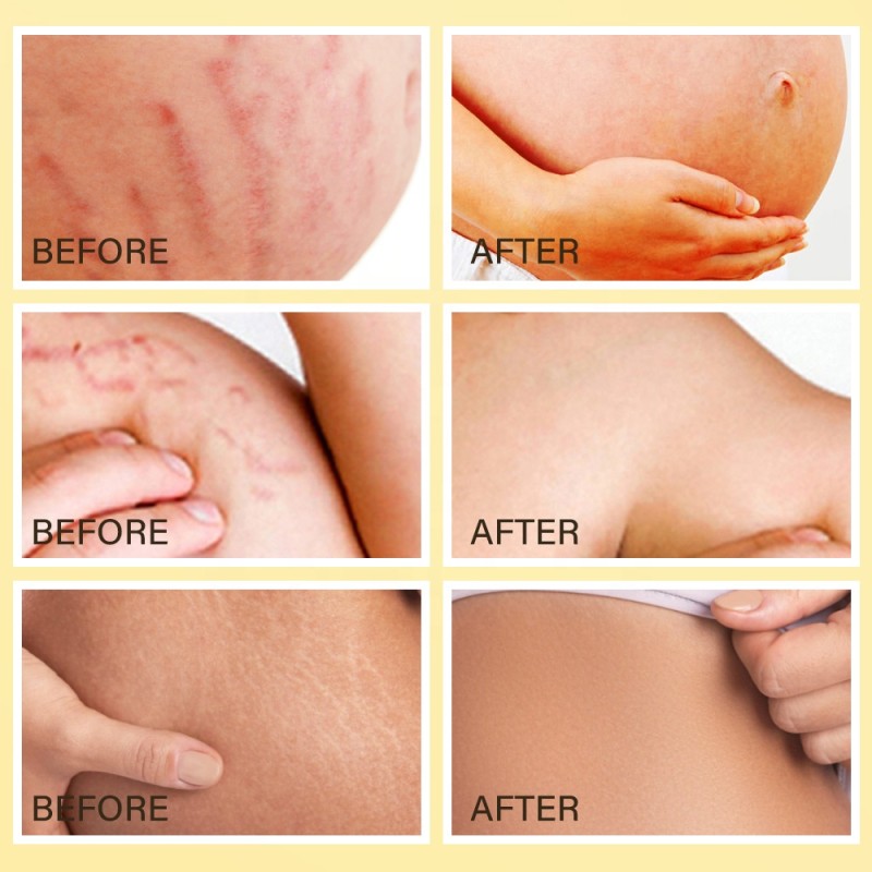 Stretch Mark Oil Supplier - OEM 100% Natural Plant Extract Scar