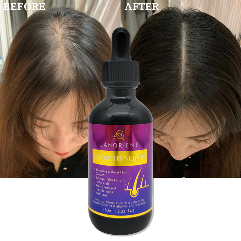 Private Label LANORIENT Natural Hair Growth Products Rosemary Anti-Hair Loss Serum Hair Growth Oil