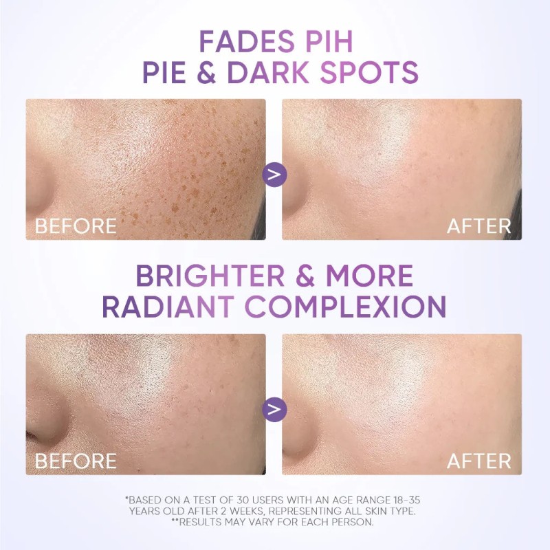 OEM ODM Skin Care Set Whitening Brightening Symwhite 377 Face Cream and Lotion with Dark Spot Moisturizer