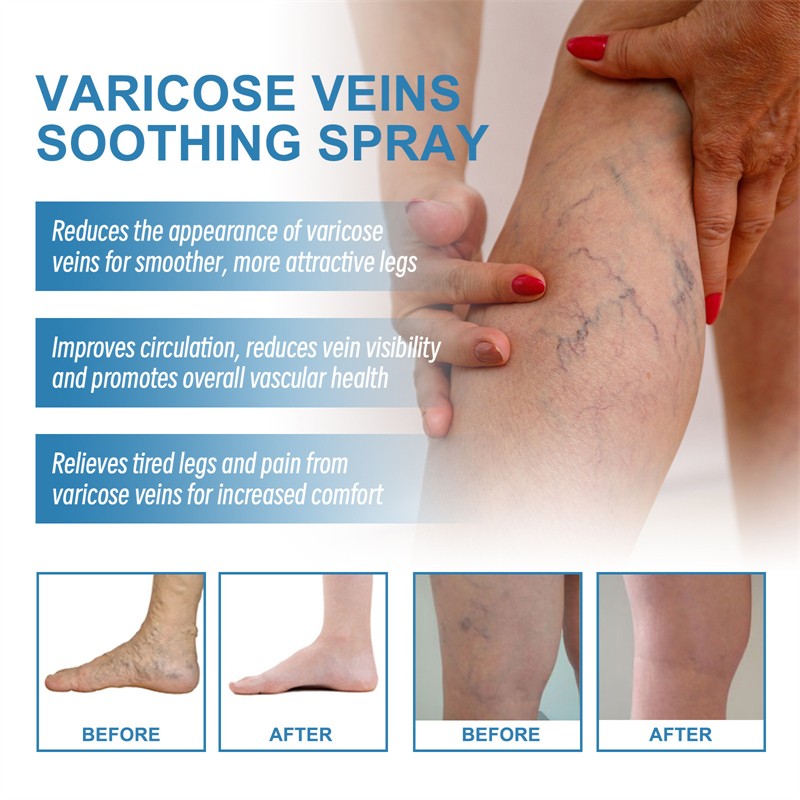 South Moon 30ml Herbal Relief Varicose Vein Remover Spray Soothing Moisturizing Varicose Veins Improving Spider Veins Removal
