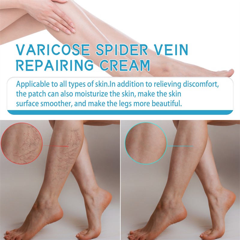 West Month Varicose Spider Vein Repairing Cream Nourishing Soothing Moisturizing Chinese Anti Varicose Vein Cream