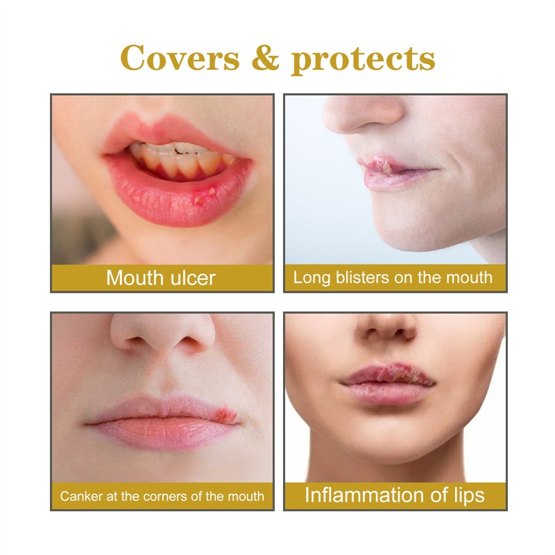 South Moon 60pcs Cold Sore Honey Patches Mouth Ulcer Herpes Abscess Swelling Long Bister Canker Relieving Patch