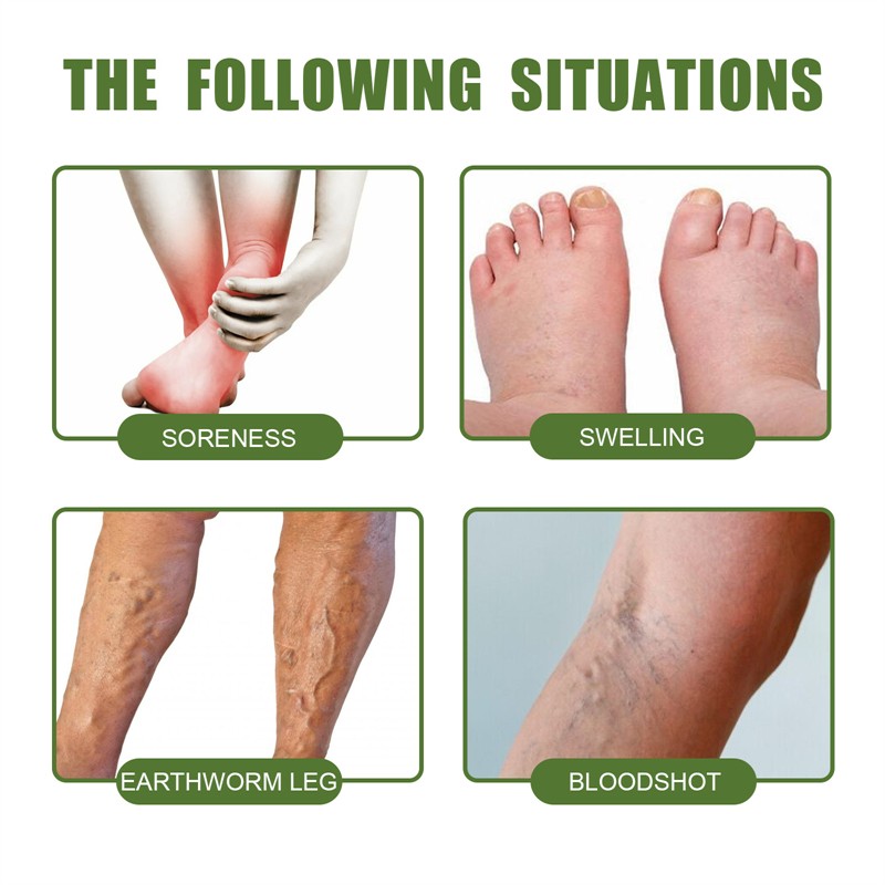 South Moon Best Instant Relief Varicose Vein Cream Soreness Swelling Earthworm Leg Relieving Spider Vein Removal Cream