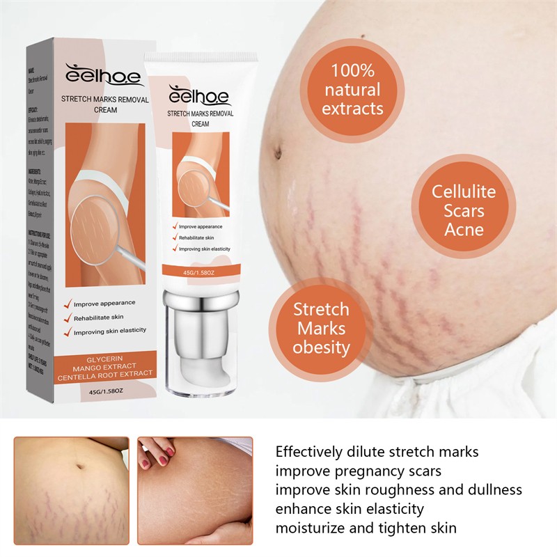 EELHOE 45g Stretch Marks Removal Cream Post Pregnancy Trace Removing Effective Stretch Mark Cream