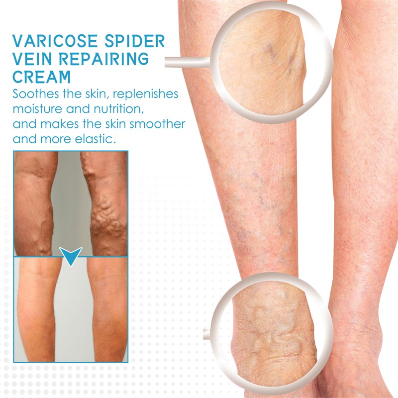 West Month Varicose Spider Vein Repairing Cream Nourishing Soothing Moisturizing Chinese Anti Varicose Vein Cream