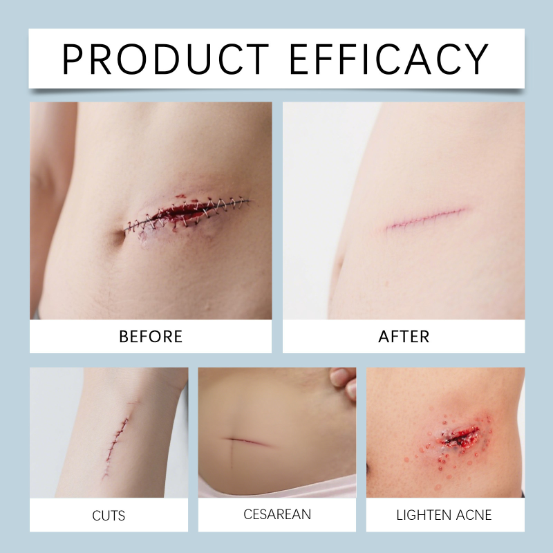 South Moon Herbal Skin Care Gel Pen Body Nourishing Smooth Refreshing Scar Removal Cream Aloe Vera Gel