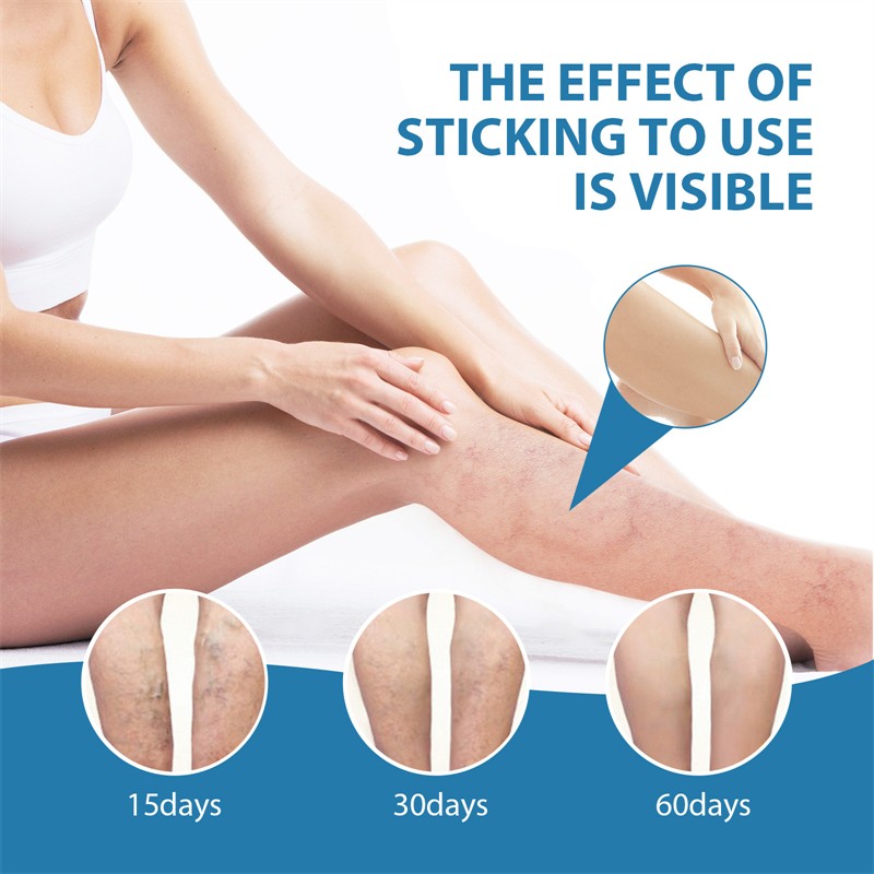 South Moon 30ml Herbal Relief Varicose Vein Remover Spray Soothing Moisturizing Varicose Veins Improving Spider Veins Removal