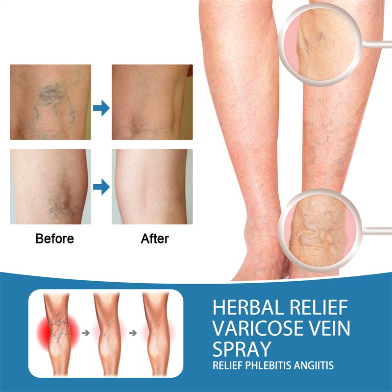 South Moon 30ml Herbal Relief Varicose Vein Remover Spray Soothing Moisturizing Varicose Veins Improving Spider Veins Removal