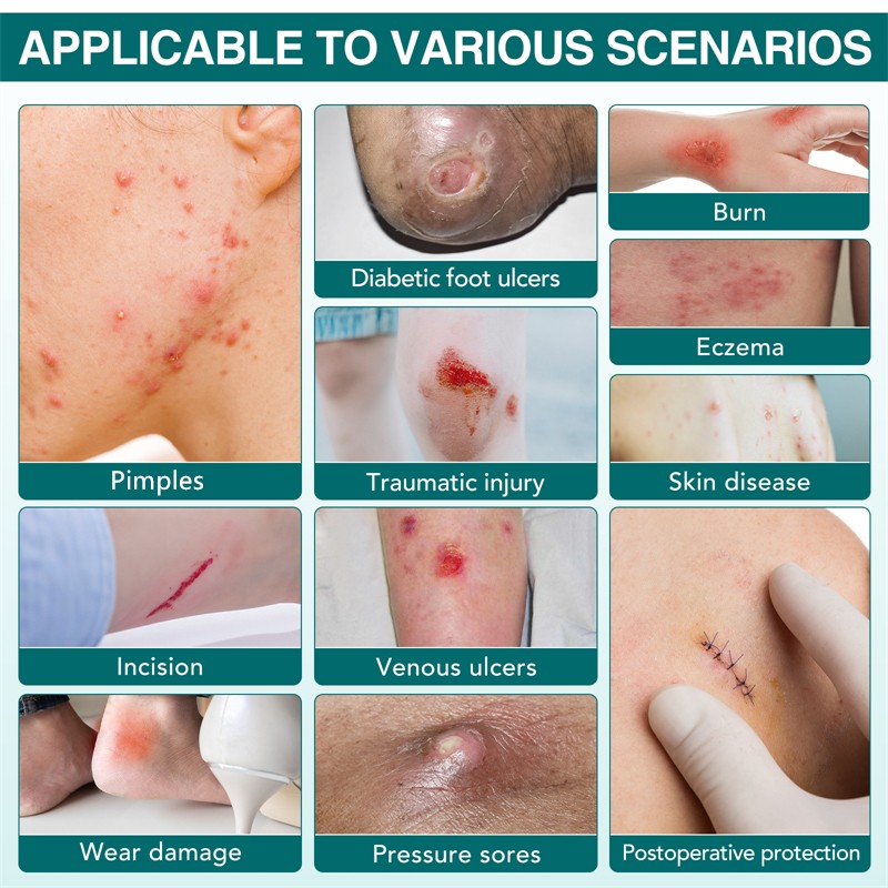 ELAIMEI Hydrocolloid Dressing Roll Scar Ulcer Traumatic Injury Burn Eczema Incision Wear Damage Pressure Sores Universal Patch