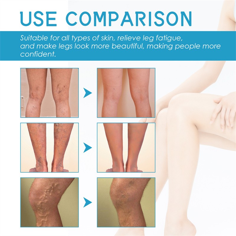 West Month Varicose Spider Vein Repairing Cream Nourishing Soothing Moisturizing Chinese Anti Varicose Vein Cream