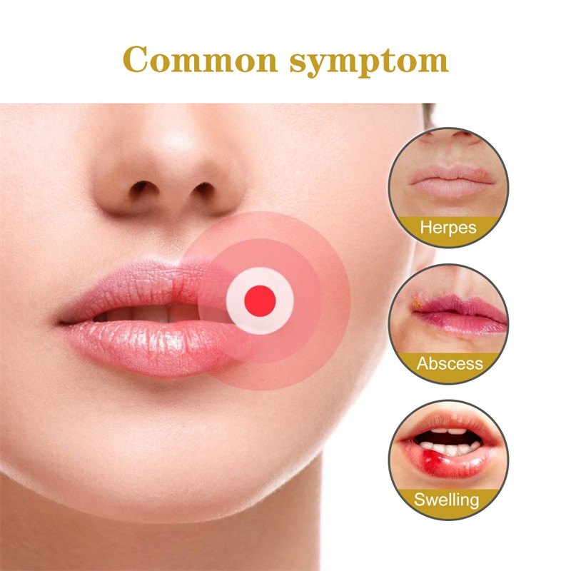 South Moon 60pcs Cold Sore Honey Patches Mouth Ulcer Herpes Abscess Swelling Long Bister Canker Relieving Patch