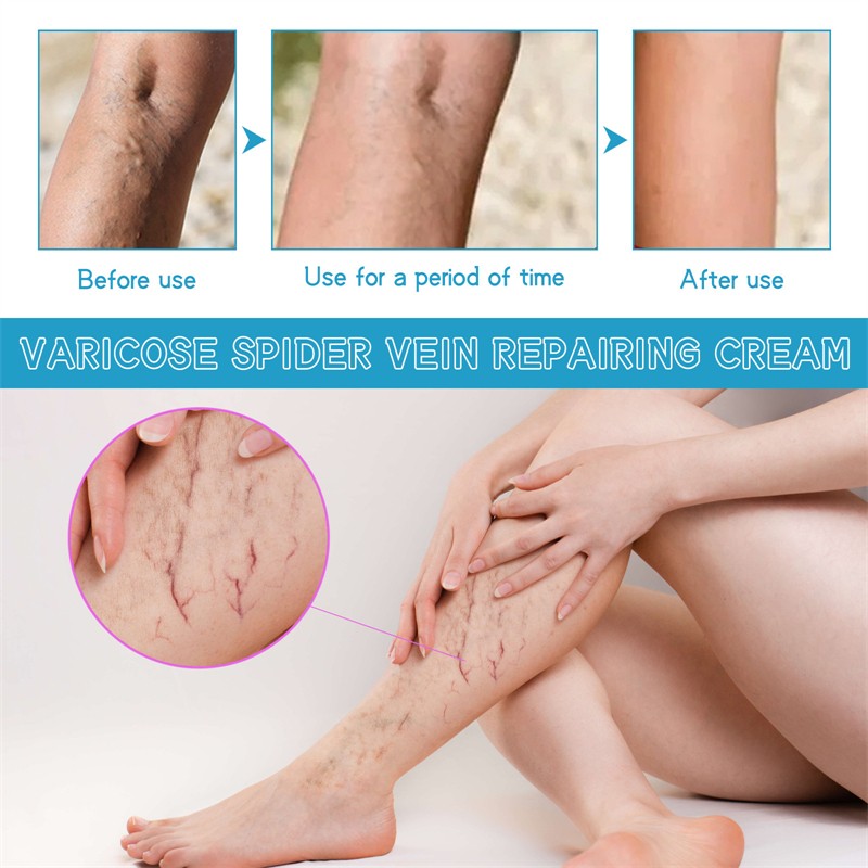 West Month Varicose Spider Vein Repairing Cream Nourishing Soothing Moisturizing Chinese Anti Varicose Vein Cream