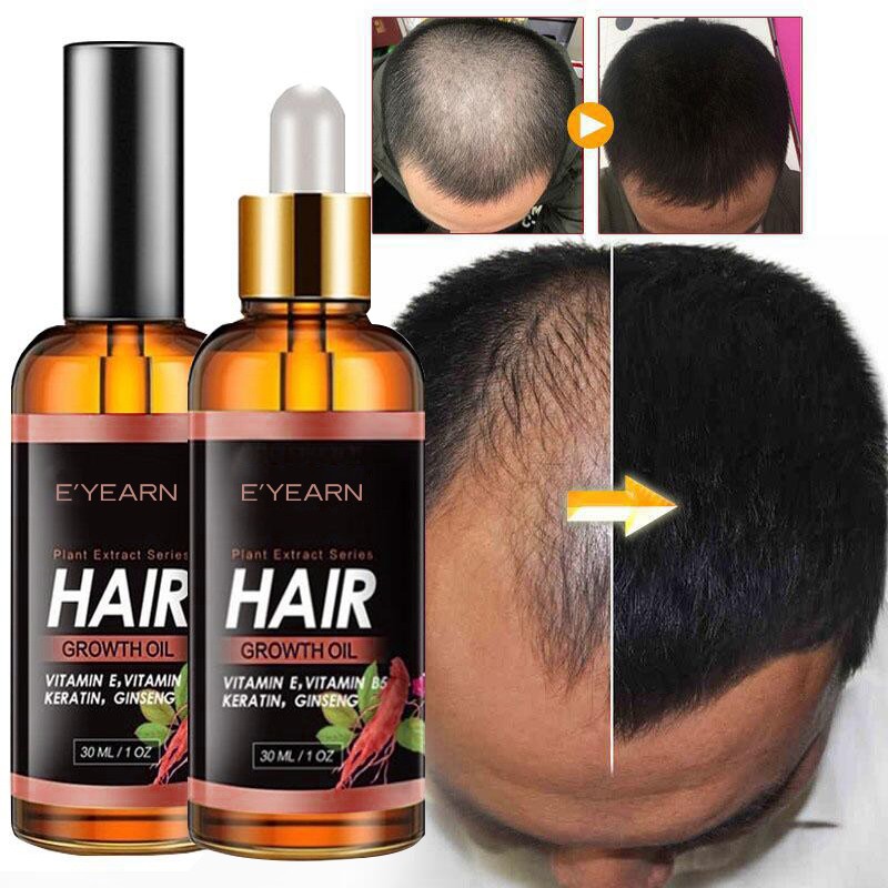 OEM High-Efficient Hair Growth Oil Ginseng Scalp Oil Anti-Hair Loss Scalp Nourishing Serum for Thicker Fuller Hair Treatment