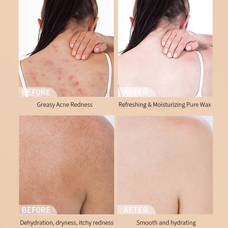 OEM Japan Sulfur Anti-mite Liquid Soap for Acne Dermatologists Approved Used to Wash Face Hands Hair and Body Cleaner Soap