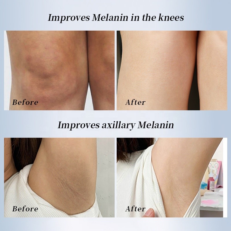 Best Dark Spot Remover Body Sensitive Skin Whitening Cream Natural Instant Effect Intimate Area Underarm Brightening Cream