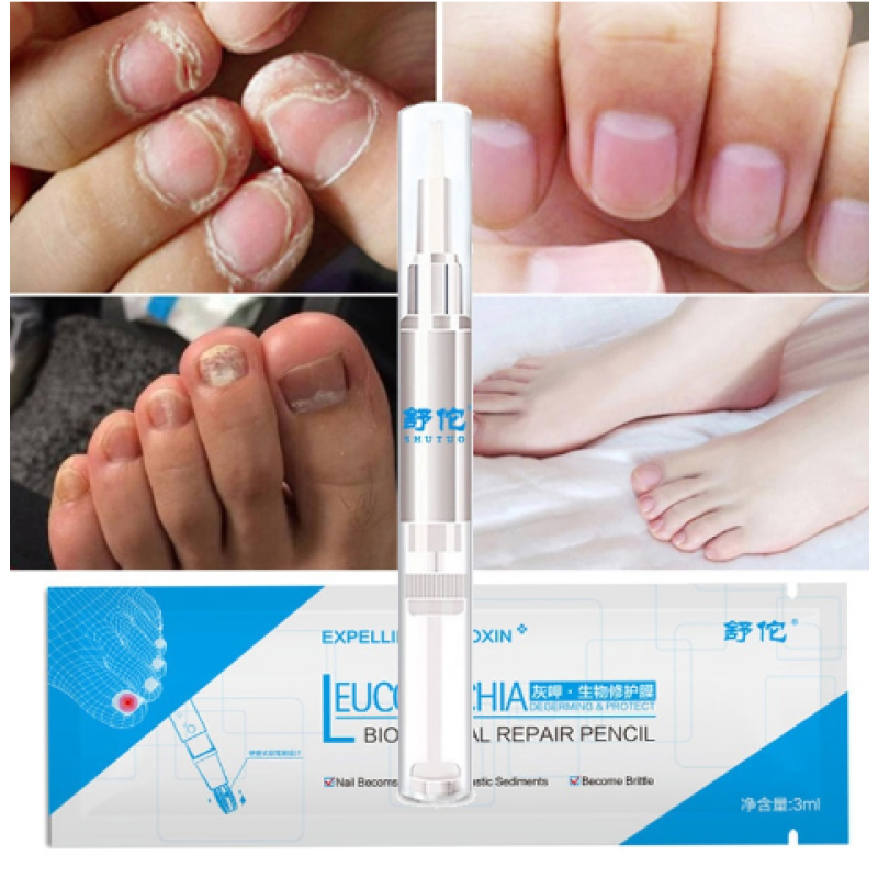 Nail Fungus Repair Treatment Pen Products Onychomycosis Paronychia Anti Fungal Nail Infection Chinese Herbal Care Oil Pen