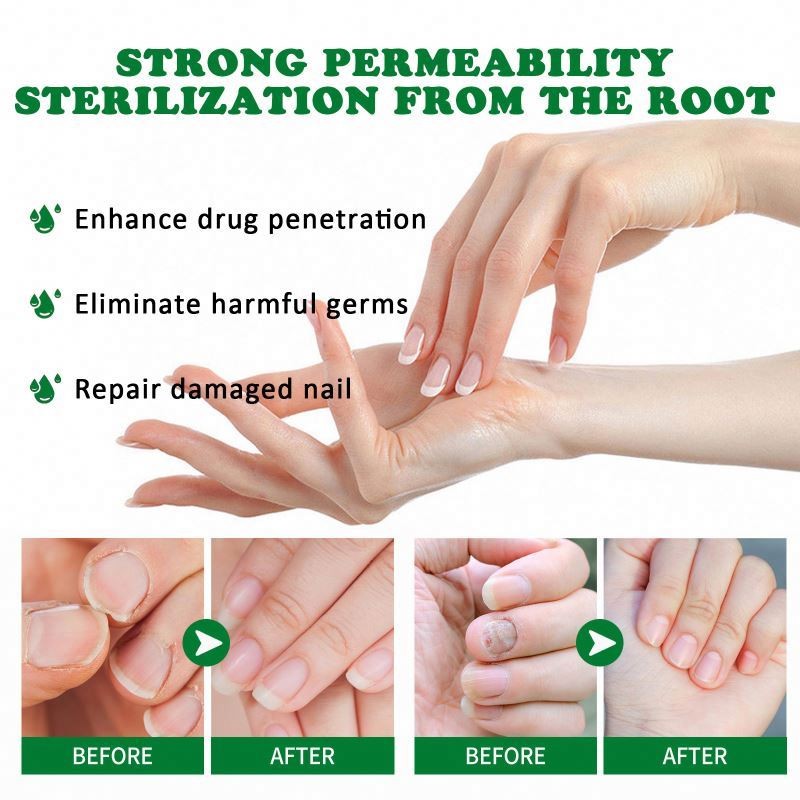 JAYSUING 7 Days Foot Hand Care Ginger Fungus Treatment Nail Fungal Cuticle Serum 30ml