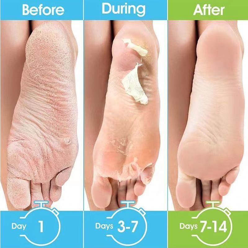 Exfoliating Foot Treatment Mask Dead Skin Remover Pedicure Peeling Feet Skin Care Socks Masks