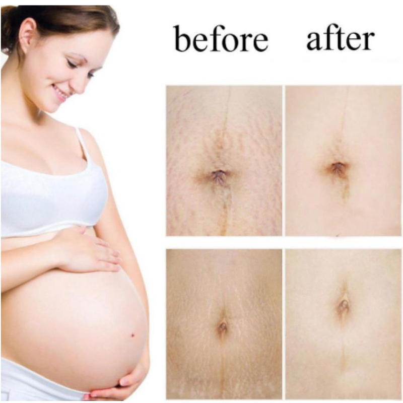2019 New Style Removal Acne Scar Stretch Marks Cream Fat Scar Striae Gravidarum Treatment
