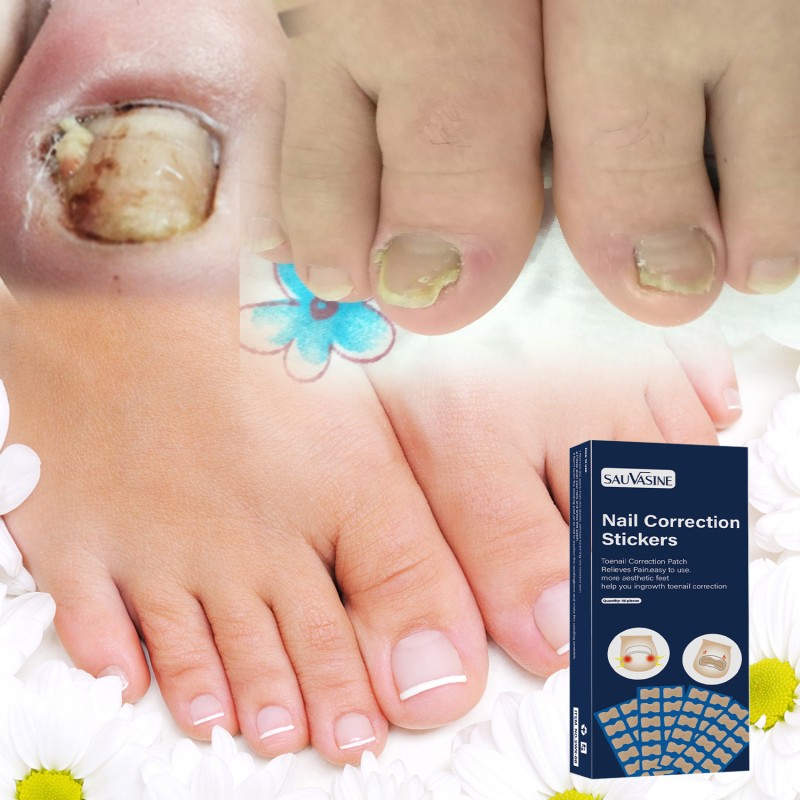 SAUVASINE Nail Ingrown Toenail Correction Sticker Fungus Care Treatment Toenail Patches 50 Pieces
