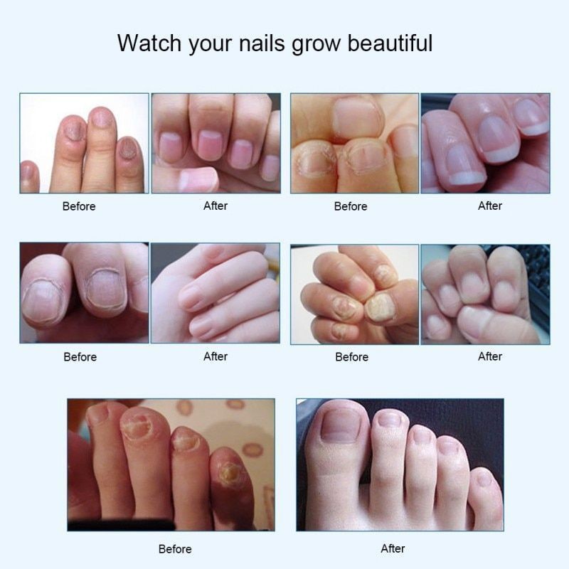 Anti Fungal Treatment Nail Pen Repair Gel 3ML Onychomycosis Paronychia Infection Herbal Toe Finger Nails Health Care