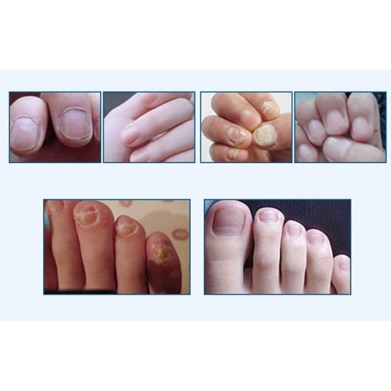 Anti Fungal Nail Treatment Liquid Toe Nail Finger Fungus Onychomycosis Repair