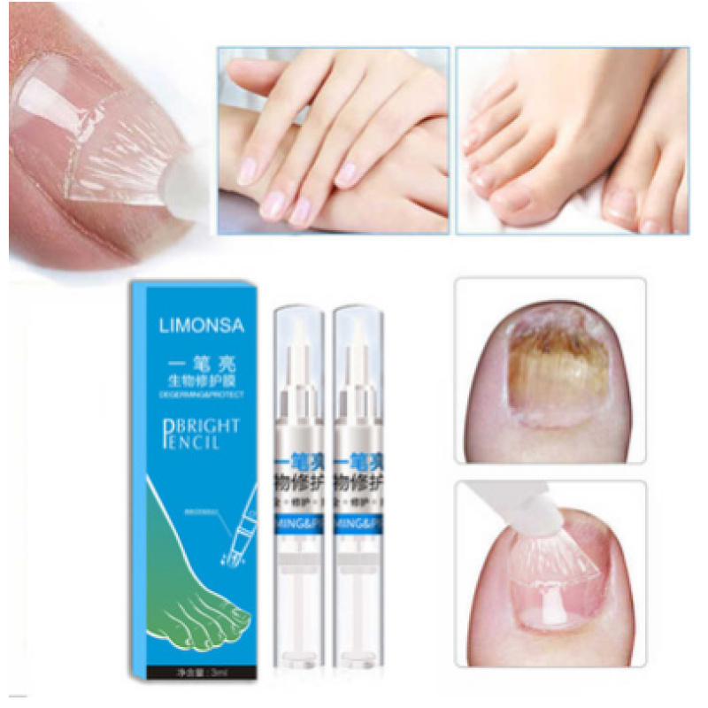 Anti Fungal Treatment Nail Pen Repair Gel 3ML Onychomycosis Paronychia Infection Herbal Toe Finger Nails Health Care