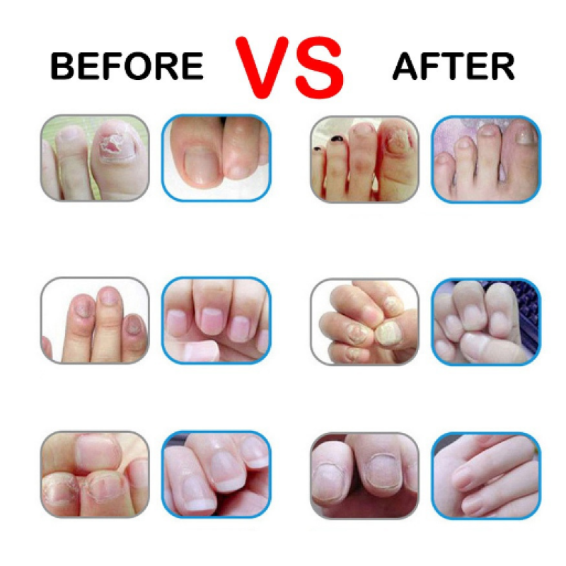 Nail Fungus Repair Treatment Pen Products Onychomycosis Paronychia Anti Fungal Nail Infection Chinese Herbal Care Oil Pen