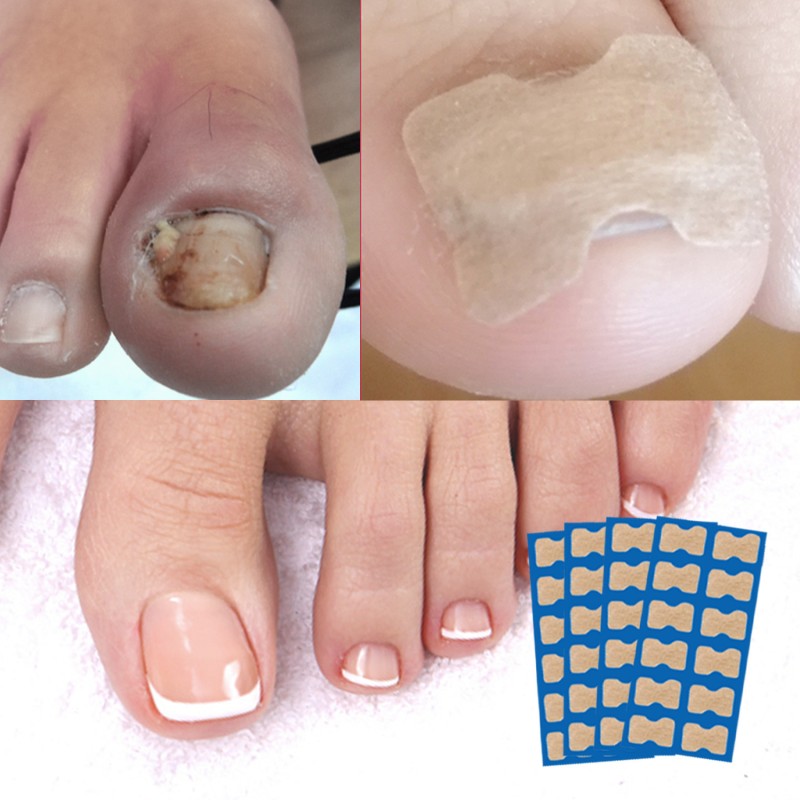 SAUVASINE Nail Ingrown Toenail Correction Sticker Fungus Care Treatment Toenail Patches 50 Pieces