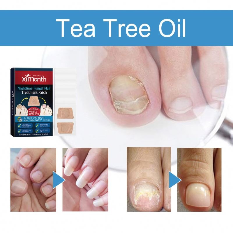 XIMONTH Nail Care Anti Fungal Natural Herbal Tea Tree Oil Night Use Fungus Treatment Nail Patches