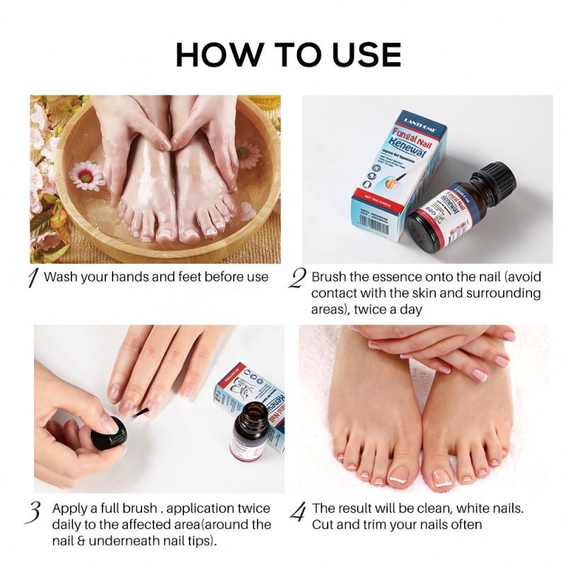 Easy to Use Improve Nail Appearance Finger Repair Solution Foot Fungus Infection Treatment for Ingrown Toe Nail