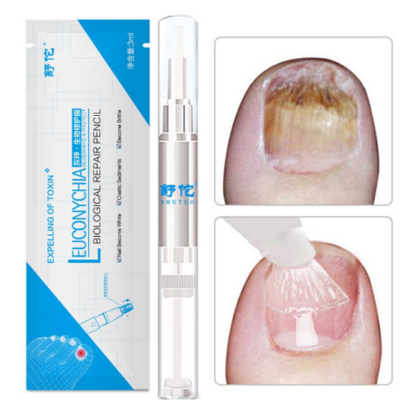 Nail Fungus Repair Treatment Pen Products Onychomycosis Paronychia Anti Fungal Nail Infection Chinese Herbal Care Oil Pen