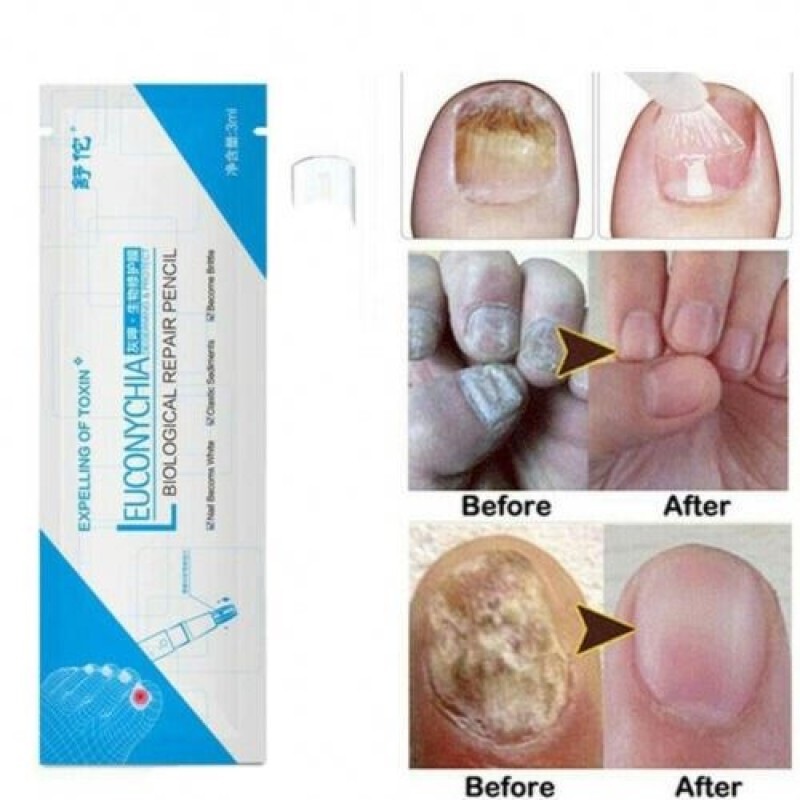Anti Fungal Nail Treatment Liquid Toe Nail Finger Fungus Onychomycosis Repair