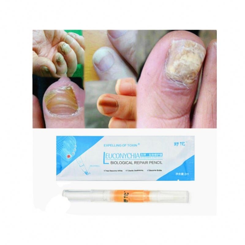 Anti Fungal Nail Treatment Liquid Toe Nail Finger Fungus Onychomycosis Repair