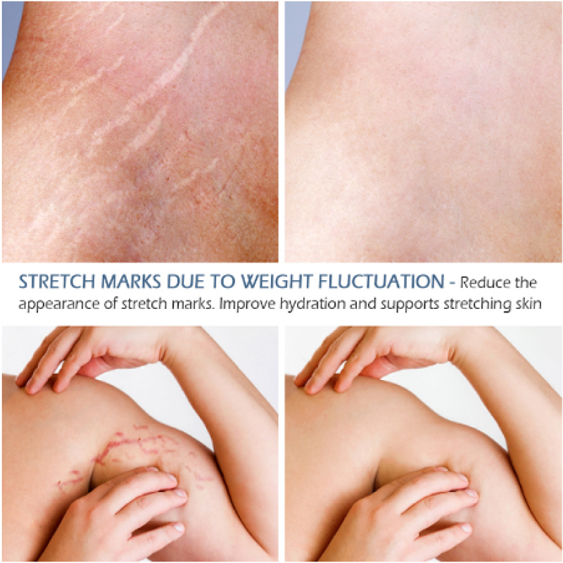 Crocodile Stretch Marks Remover Cream Ance Maternity Repair Anti Aging Winkles Firming Body Care Pregnancy Scars