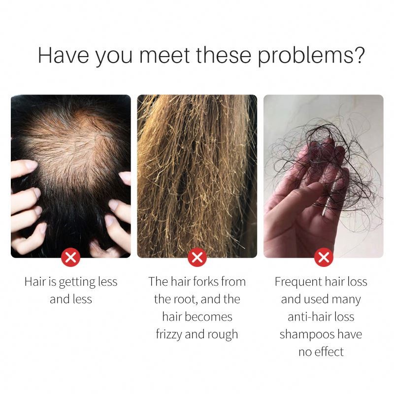 SAUVASINE 100% Natural Organic Onion Hair Growth Oil Nourishing Anti-Hair Loss Formula