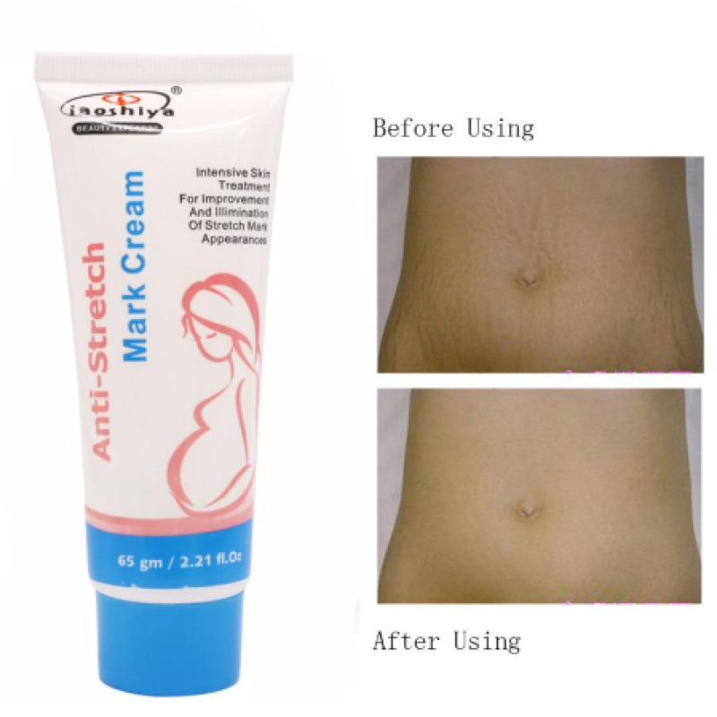2019 New Style Removal Acne Scar Stretch Marks Cream Fat Scar Striae Gravidarum Treatment