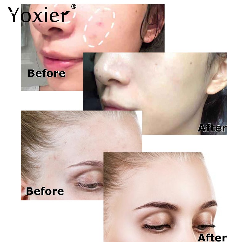 36pcs Acne Dressing Spot Patch Pimple Remover Tool Set Face Cream Skin Care Blemish Treatment Invisible Acne Stickers