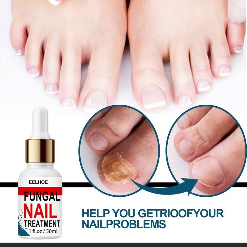 Eelhoe Repair Nail Smoothing Essence Onychomycosis Liquid Nails Press on Polish