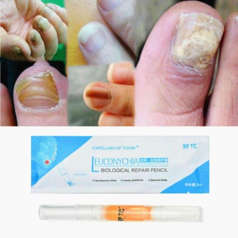 Anti Fungal Nail Treatment Liquid Toe Nail Finger Fungus Onychomycosis Repair