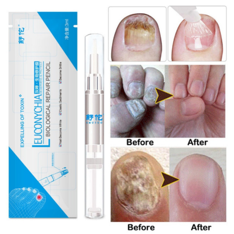 Nail Fungus Repair Treatment Pen Products Onychomycosis Paronychia Anti Fungal Nail Infection Chinese Herbal Care Oil Pen
