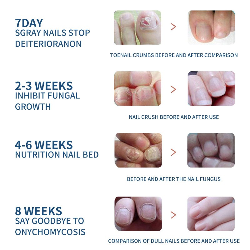 OEM Wholesale Transparent Nutrient Fungal Nail Repair Patch Moisturizing Gray Nail Repair Protects Cortex Nail Supplies