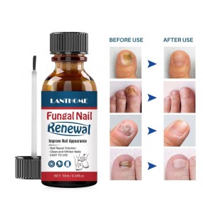 Easy to Use Improve Nail Appearance Finger Repair Solution Foot Fungus Infection Treatment for Ingrown Toe Nail