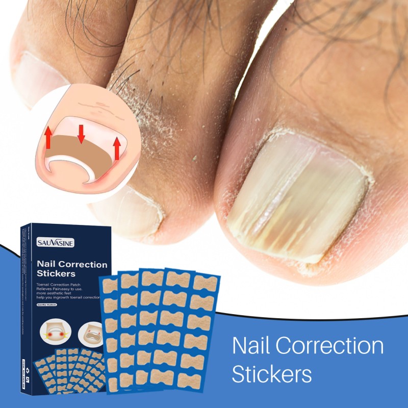 SAUVASINE Nail Ingrown Toenail Correction Sticker Fungus Care Treatment Toenail Patches 50 Pieces