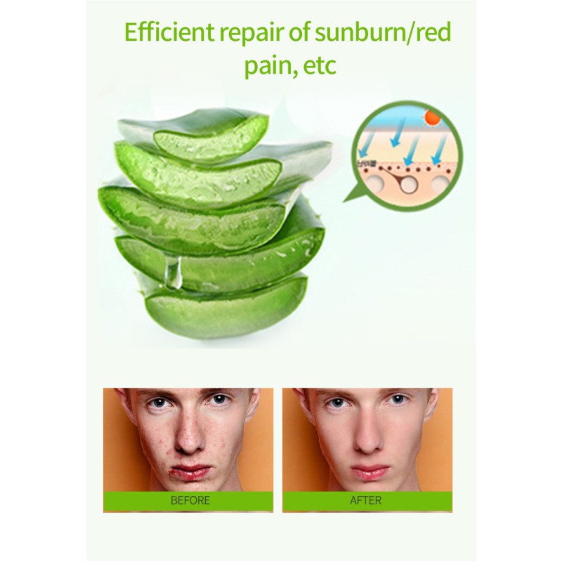 Factory Wholesale Natural Aloe Vera Antibacterial Cream Clear Facial Pimples Antibacterial Ointment